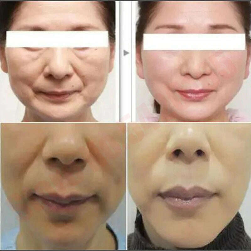 Korean Protein Thread Gold Protein Line Absorbable Anti-wrinkle Face Filler Women Beauty Care Skin Collagen Based - KIMLUD